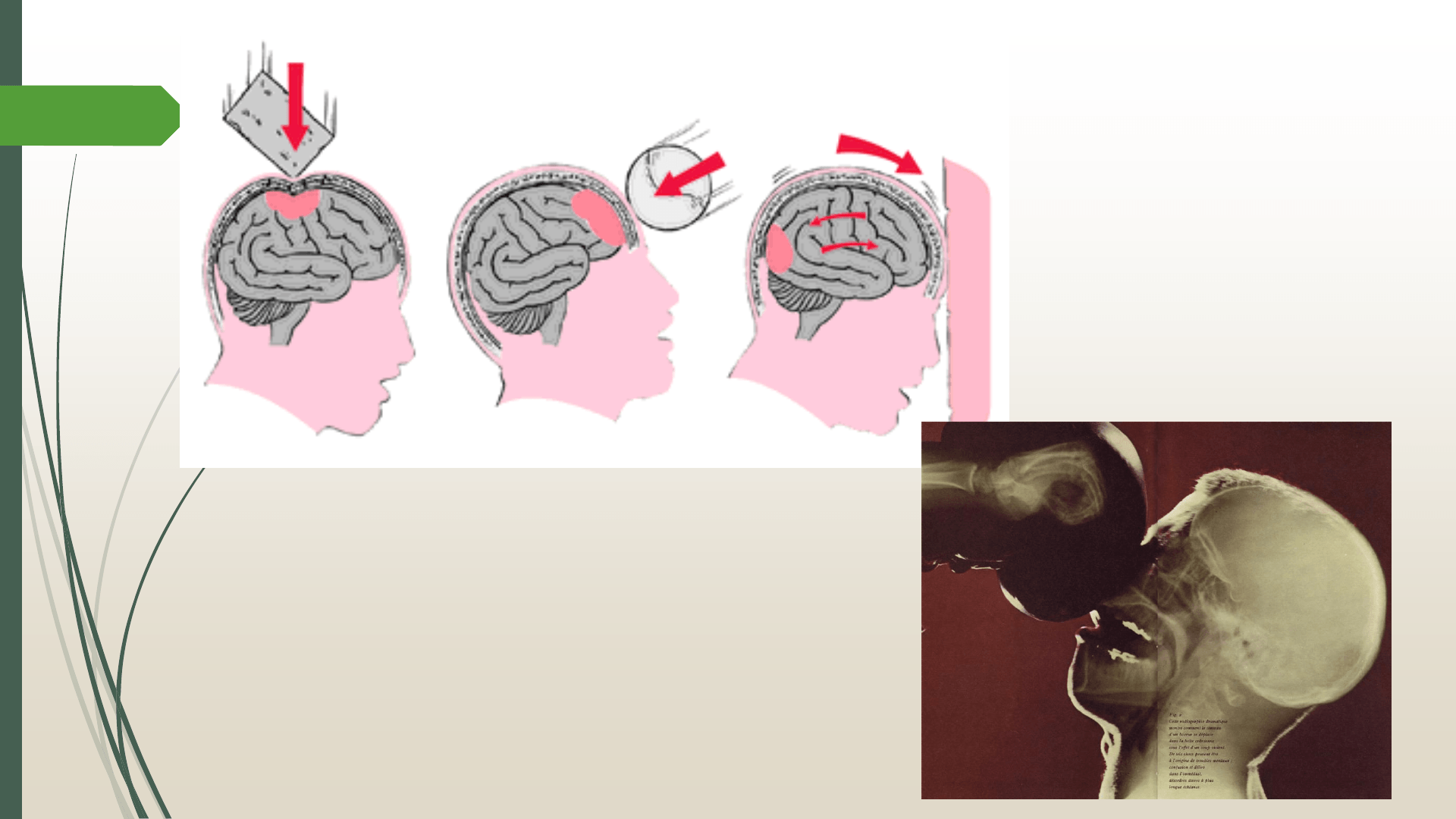 Unidad 10 Daño cerebral y plasticidad neuronal ante el daño Filadd